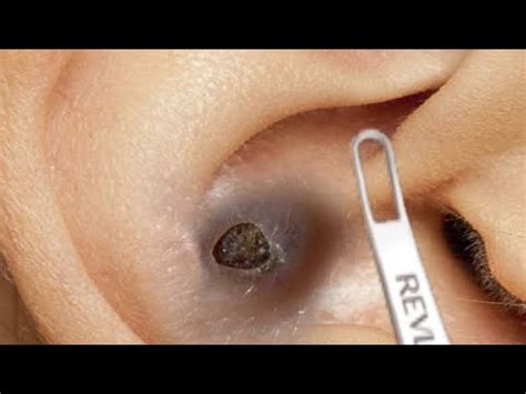 Blackhead Extraction. . Ear pimple popping videos 2022